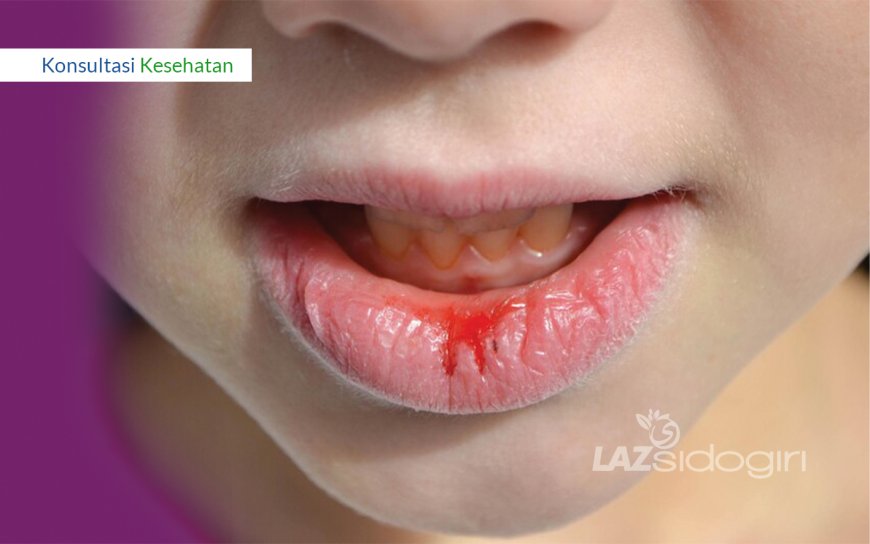 KULIT TANGAN KERING MENGELUPAS, BIBIR PECAH-PECAH, DAN SARIAWAN