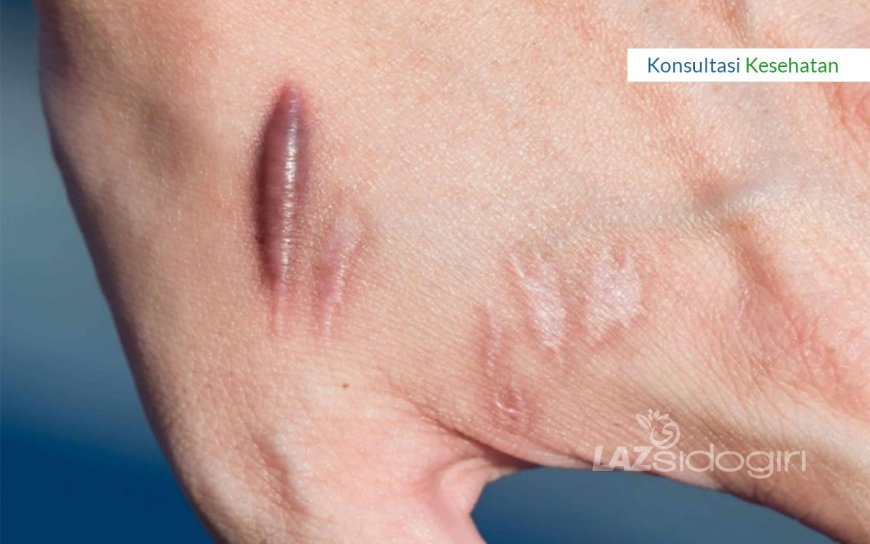 KELOID DAN CARA MENGHILANGKANNYA